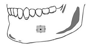 mental_foramen_1